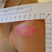 Abrasion of the shoulder (fall on roller skates): 7. day